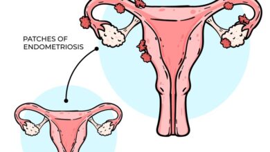 endometriosis a women's uterus problem