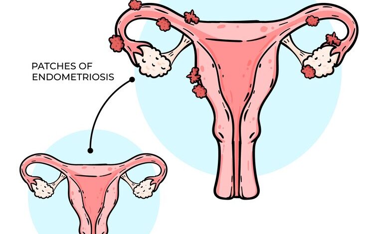 endometriosis a women's uterus problem