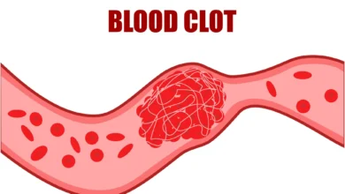 Blood Clots