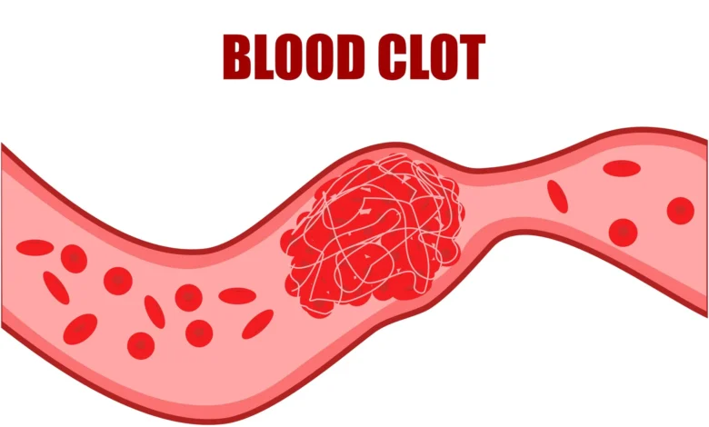 Blood Clots